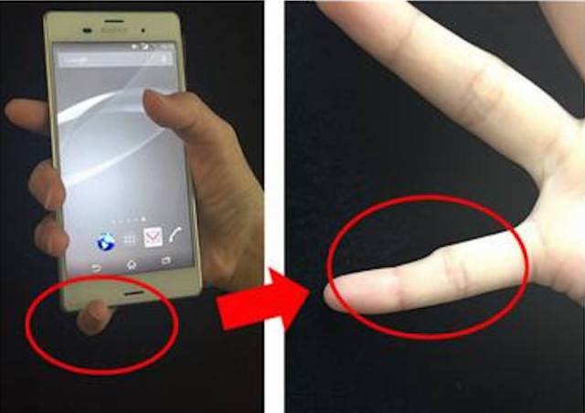 Is smartphone pinky the new text claw? Overuse of mobile devices found to cause finger deformity