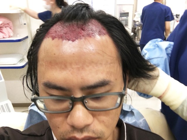 Our Japanese language reporter tries out hair replacement surgery (viewer  discretion is advised) | SoraNews24 -Japan News-