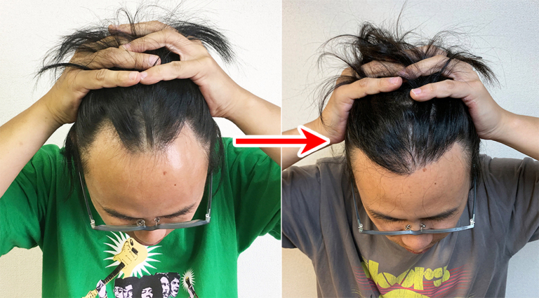 Is it okay to bleach hair that has been surgically transplanted? Seiji  reports on his hairline | SoraNews24 -Japan News-