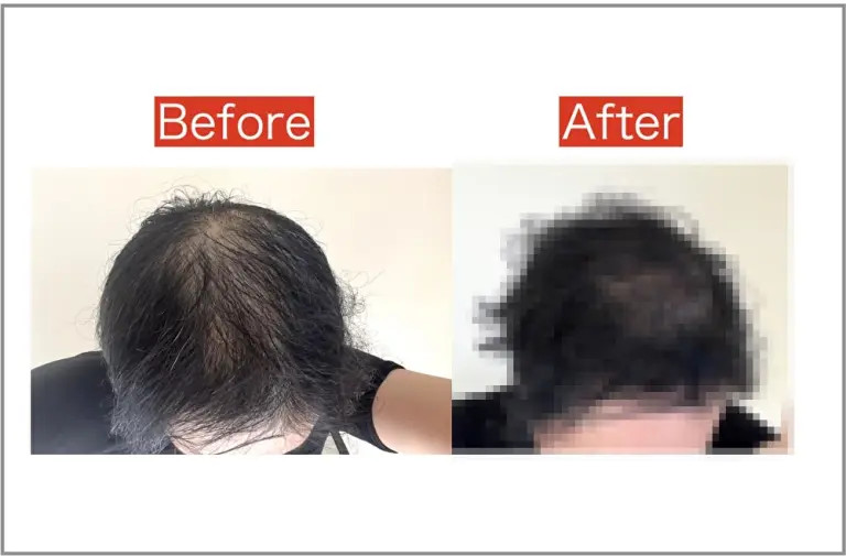 Does getting a perm help hide the thinning hair spots on your head? We try  it and find out | SoraNews24 -Japan News-